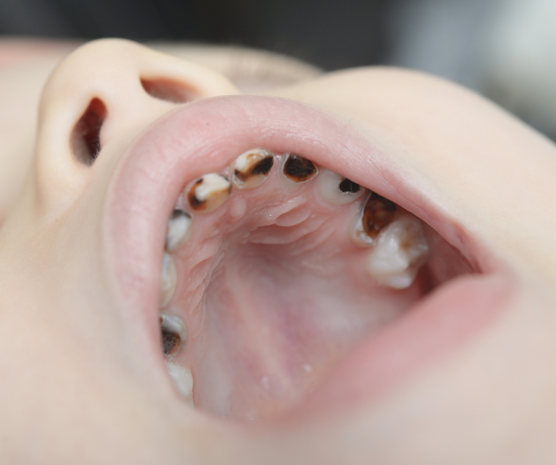 How Long Does It Take For A Cavity To Form In A Child