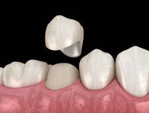 Illustration of a dental crown being placed onto a damaged tooth