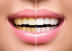 A close-up view of a woman's mouth before and after teeth whitening. The two halves of her face of before and after are placed side-by-side.