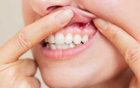 Causes, Symptoms, and Treatment Options for Gum Disease