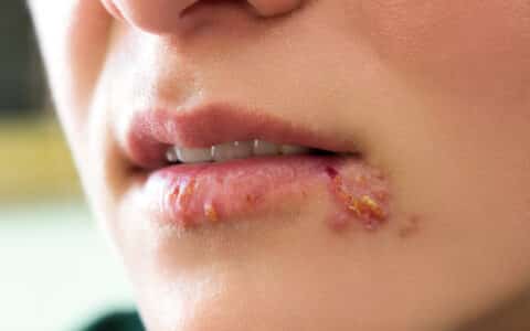 Cold Sores and Winter Seem to Go Hand in Hand