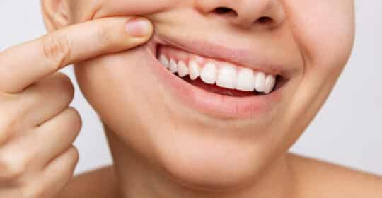 How Are Your Gums? It’s National Gum Care Month!