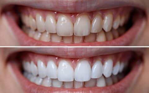 How to Achieve and Maintain a Brighter Smile at Evanson Dental