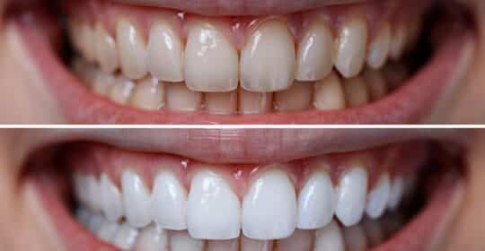 How to Achieve and Maintain a Brighter Smile at Evanson Dental