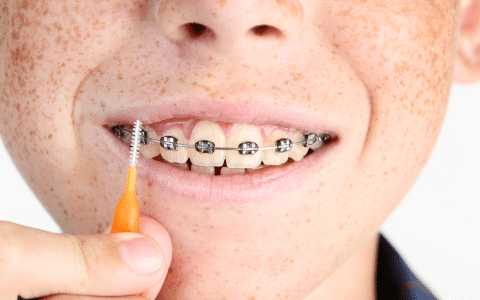 How to Care for Your Teeth While Wearing Braces