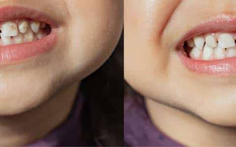My Child’s Teeth Look Stained