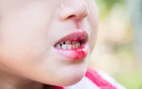 Prepare for Dental Emergencies When the Kids Come Home for the Summer