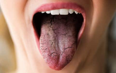 Prevent Dry Mouth With These Tips from Evanson Dental