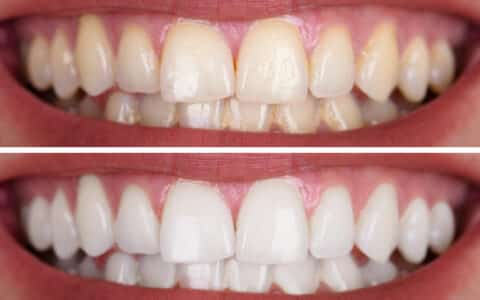 Types, Causes, and Treatments of Teeth Stains