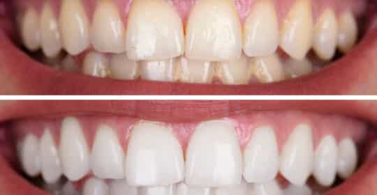 Types, Causes, and Treatments of Teeth Stains