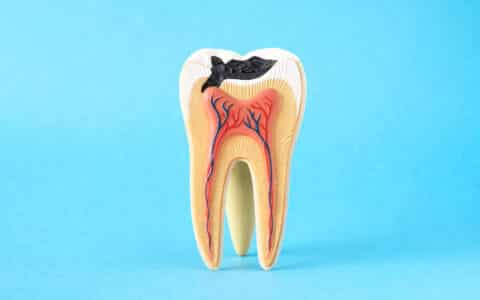 What Causes Cavities and How to Prevent Them