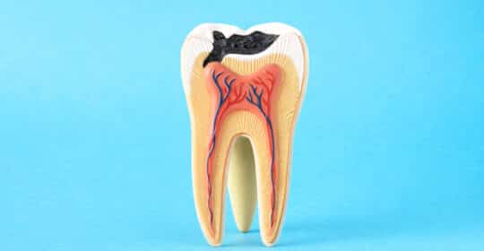 What Causes Cavities and How to Prevent Them